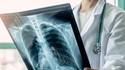 Meghalaya: TB dona kawngah technology thar ber hmang